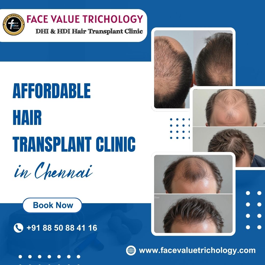 Affordable Hair Transplant Clinic In Chennai