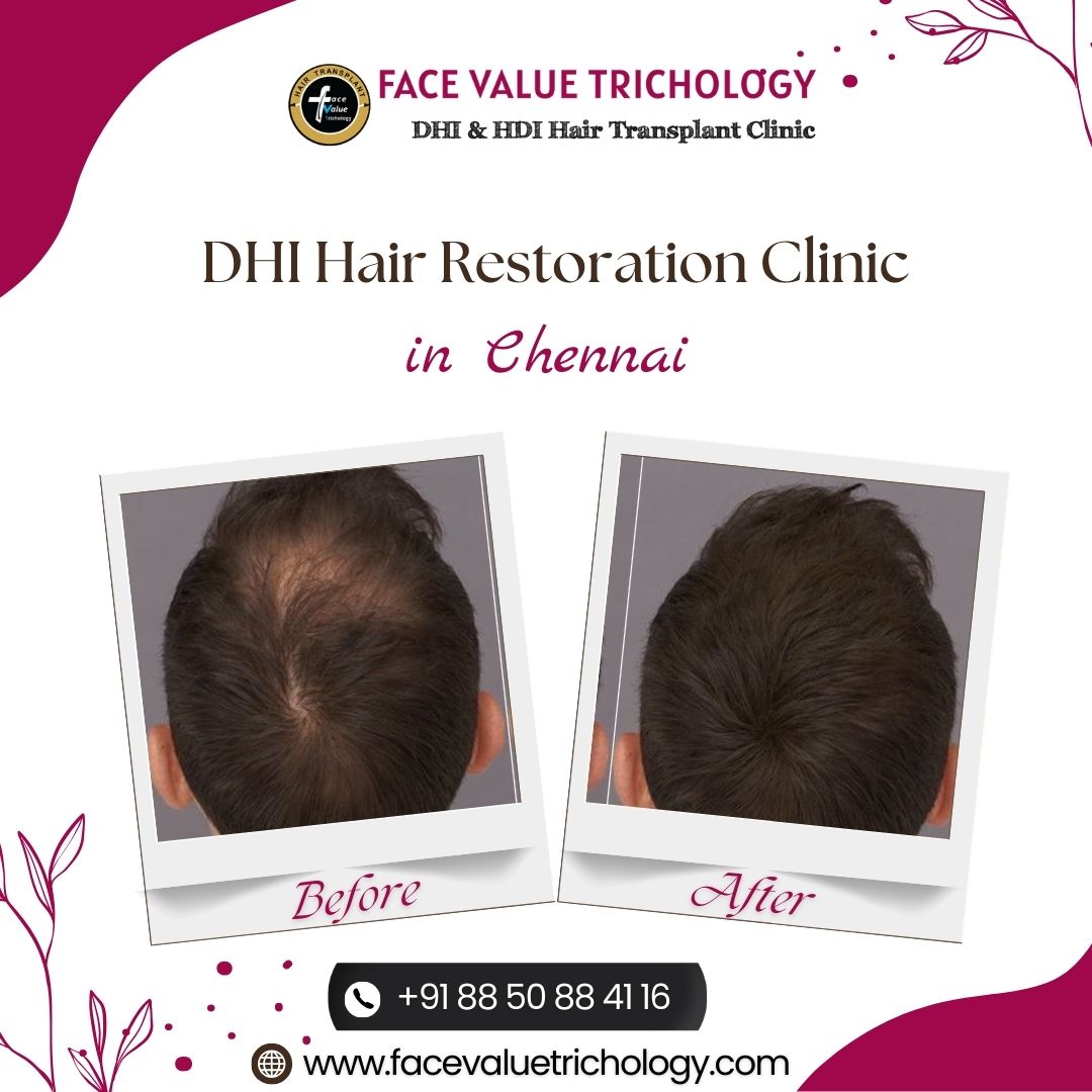 Dhi Hair Restoration Clinic In Chennai