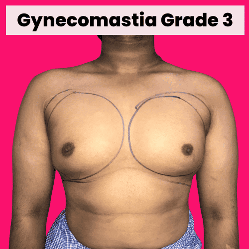 Gynecomastia