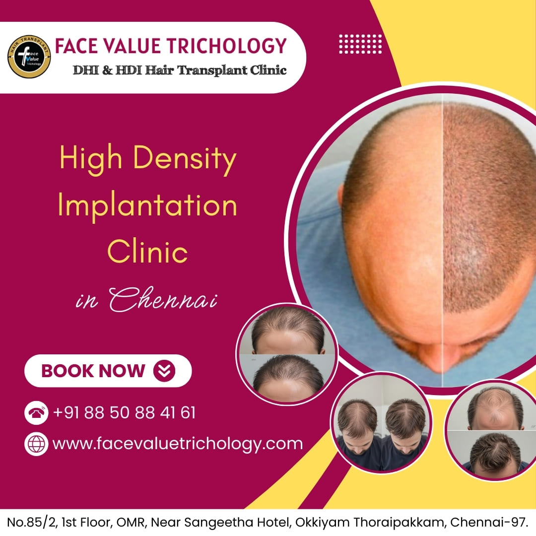 High Density Implantation(hdi) Clinic In Chennai