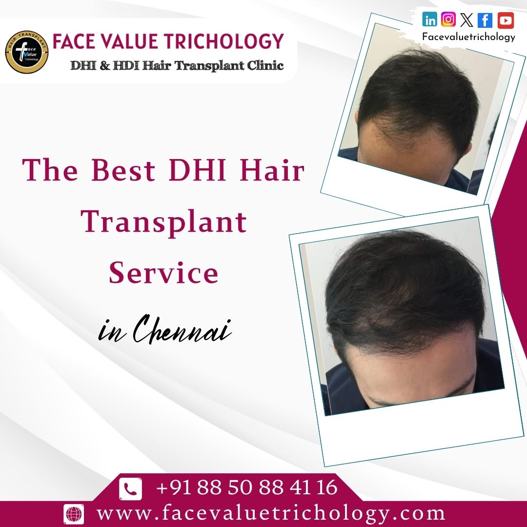 The Best Dhi Hair Transplant Service In Chennai